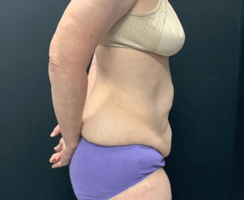 59-year-old female shown 3.5 months after full abdominoplasty with flankplasty and liposuction