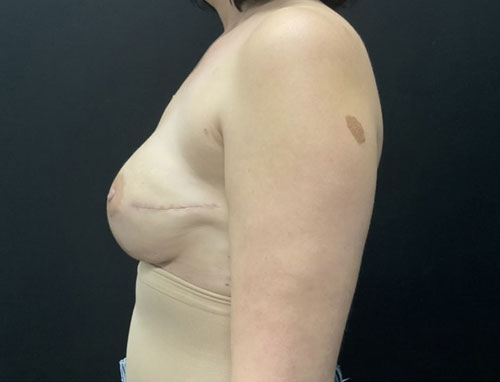 39 year old female 1 month after bilateral breast reconstruction with 415 cc moderate profile plus Sientra gel implants. This was a 2 stage reconstruction with placement of tissue expanders at the time of nipple sparing mastectomy.