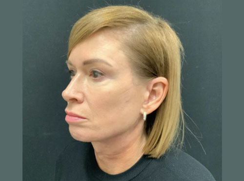 4 months after face and neck lift.