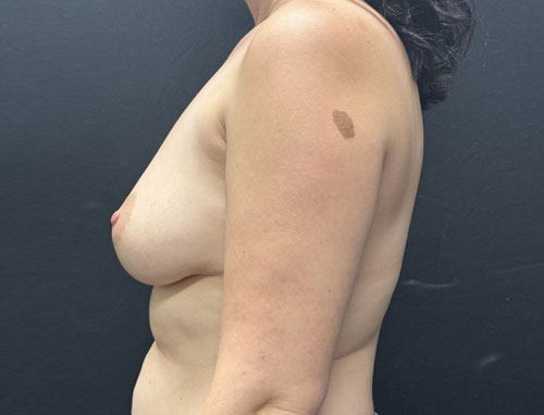 39 year old female 1 month after bilateral breast reconstruction with 415 cc moderate profile plus Sientra gel implants. This was a 2 stage reconstruction with placement of tissue expanders at the time of nipple sparing mastectomy.