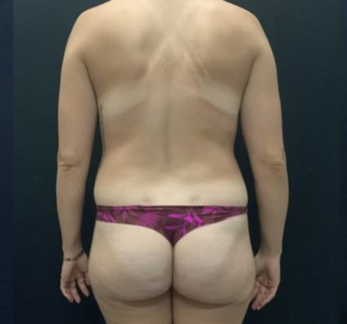 31 year old female shown 3.5 months after bilateral breast augmentation with 335 moderate profile Sientra gel implants, Durasorb, mastopexy and axillary liposuction. Her abdominal procedures included full abdominoplasty with 360 degree liposuction