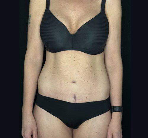 48 year old female shown 3 months after circumferential abdominoplasty, liposuction and gluteal lift with auto augmentation