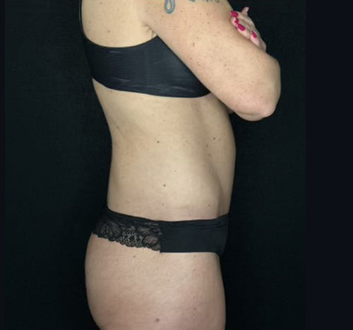 48 year old female shown 3 months after circumferential abdominoplasty, liposuction and gluteal lift with auto augmentation