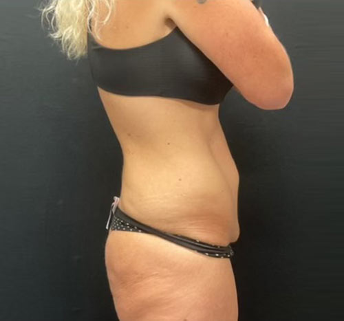 48 year old female shown 3 months after circumferential abdominoplasty, liposuction and gluteal lift with auto augmentation