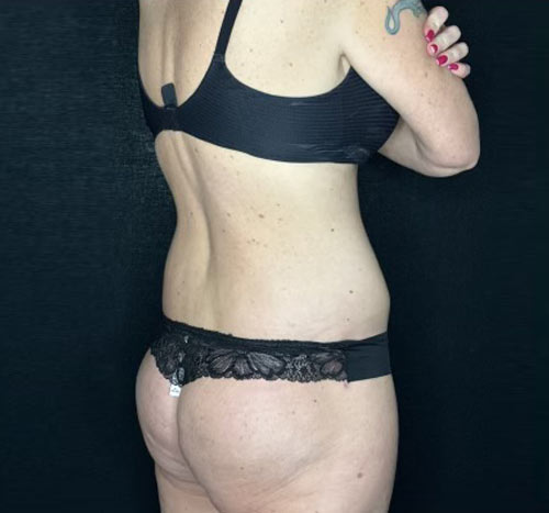 48 year old female shown 3 months after circumferential abdominoplasty, liposuction and gluteal lift with auto augmentation