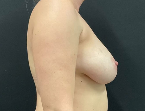 Woman in her 30s about 3 months after bilateral mastopexy