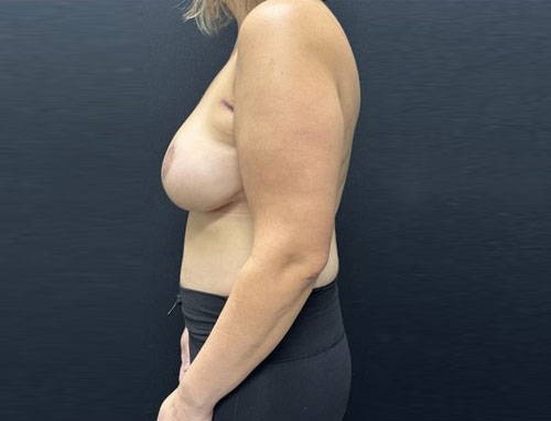 40 year old female shown three months after full abdominoplasty with 360° liposuction and bilateral mastpexy with auto augmentation and internal bra placement