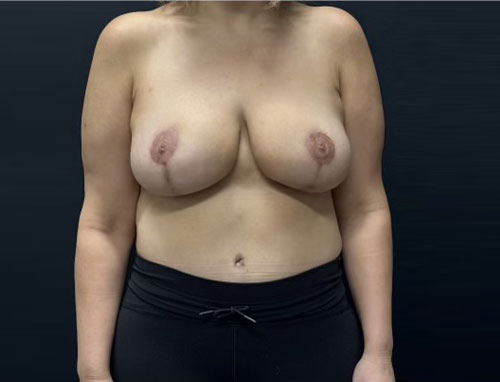 40 year old female shown three months after full abdominoplasty with 360° liposuction and bilateral mastpexy with auto augmentation and internal bra placement
