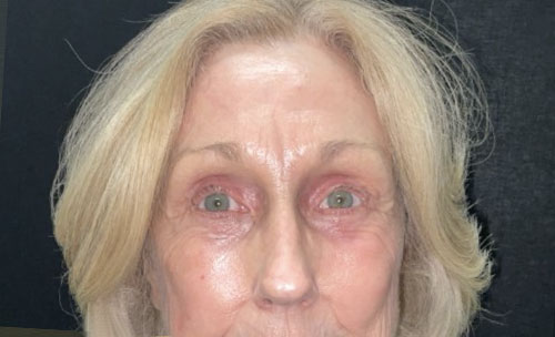 Before and 3 months After Brow Lift, Upper and Lower blepharoplasty, and TCA chemical peel of the face