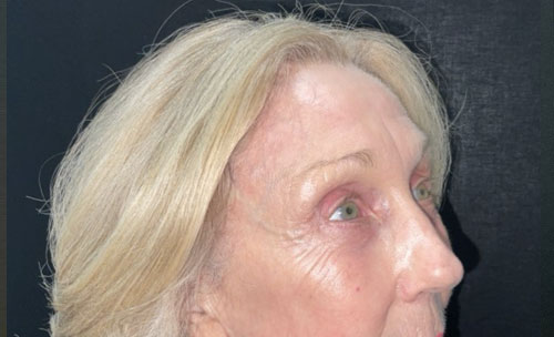 Before and 3 months After Brow Lift, Upper and Lower blepharoplasty, and TCA chemical peel of the face