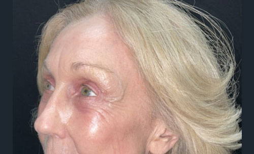 Before and 3 months After Brow Lift, Upper and Lower blepharoplasty, and TCA chemical peel of the face