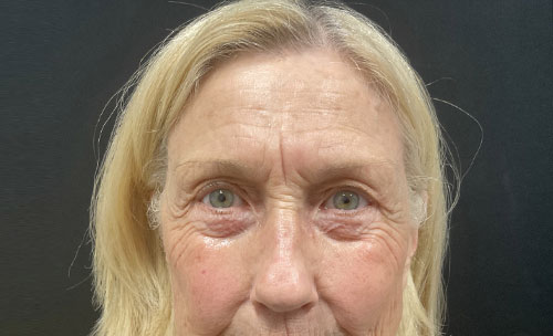 Before and 3 months After Brow Lift, Upper and Lower blepharoplasty, and TCA chemical peel of the face