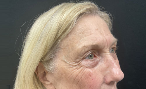 Before and 3 months After Brow Lift, Upper and Lower blepharoplasty, and TCA chemical peel of the face