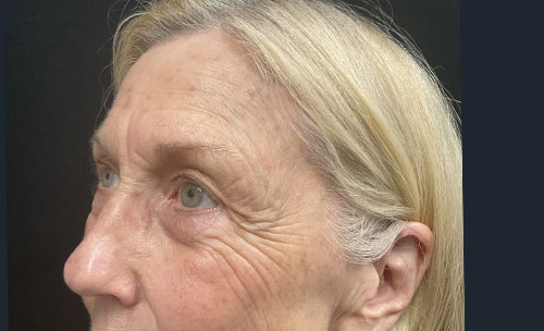 Before and 3 months After Brow Lift, Upper and Lower blepharoplasty, and TCA chemical peel of the face