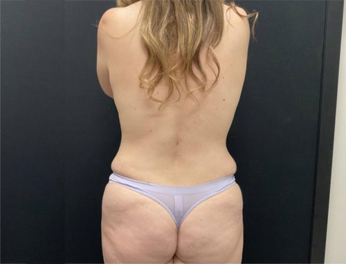35 year old patient 3 months after bilateral dual plane breast augmentation with 325 cc HP smooth round Sientra implants, right periareolar mastopexy, full abdominoplasty and 360 liposuction.