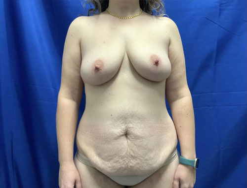 35 year old patient 3 months after bilateral dual plane breast augmentation with 325 cc HP smooth round Sientra implants, right periareolar mastopexy, full abdominoplasty and 360 liposuction.