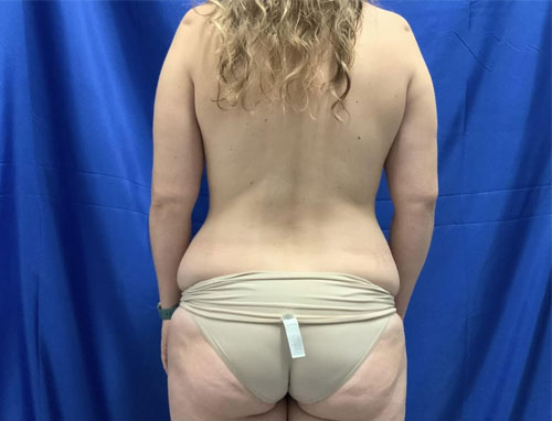 35 year old patient 3 months after bilateral dual plane breast augmentation with 325 cc HP smooth round Sientra implants, right periareolar mastopexy, full abdominoplasty and 360 liposuction.