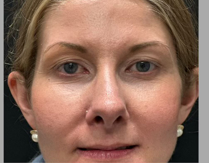 35 year old shown 3 months after functional and cosmetic rhinoplasty. Her goals were to improve breathing and reduce “hanging”columella.