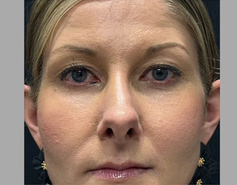 35 year old shown 3 months after functional and cosmetic rhinoplasty. Her goals were to improve breathing and reduce “hanging”columella.