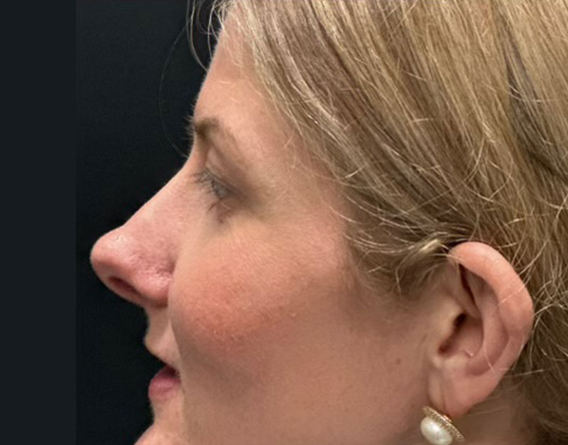 35 year old shown 3 months after functional and cosmetic rhinoplasty. Her goals were to improve breathing and reduce “hanging”columella.