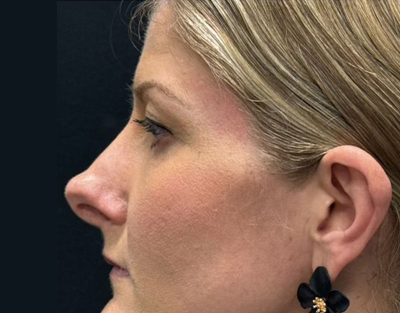 35 year old shown 3 months after functional and cosmetic rhinoplasty. Her goals were to improve breathing and reduce “hanging”columella.