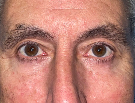 Lower Eyelid Lift before and after patient front view