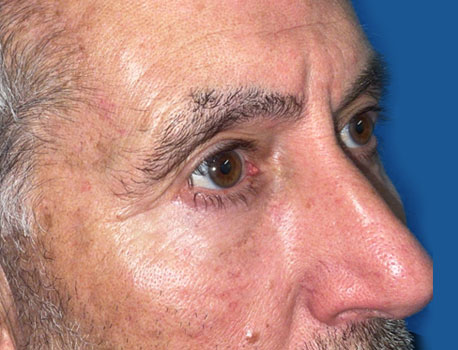 Lower Eyelid Lift before and after patient right view