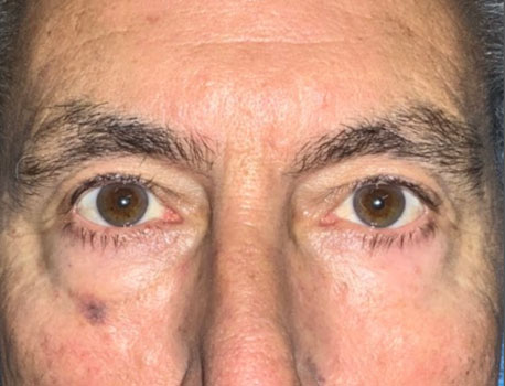 Lower Eyelid Lift before and after patient front view