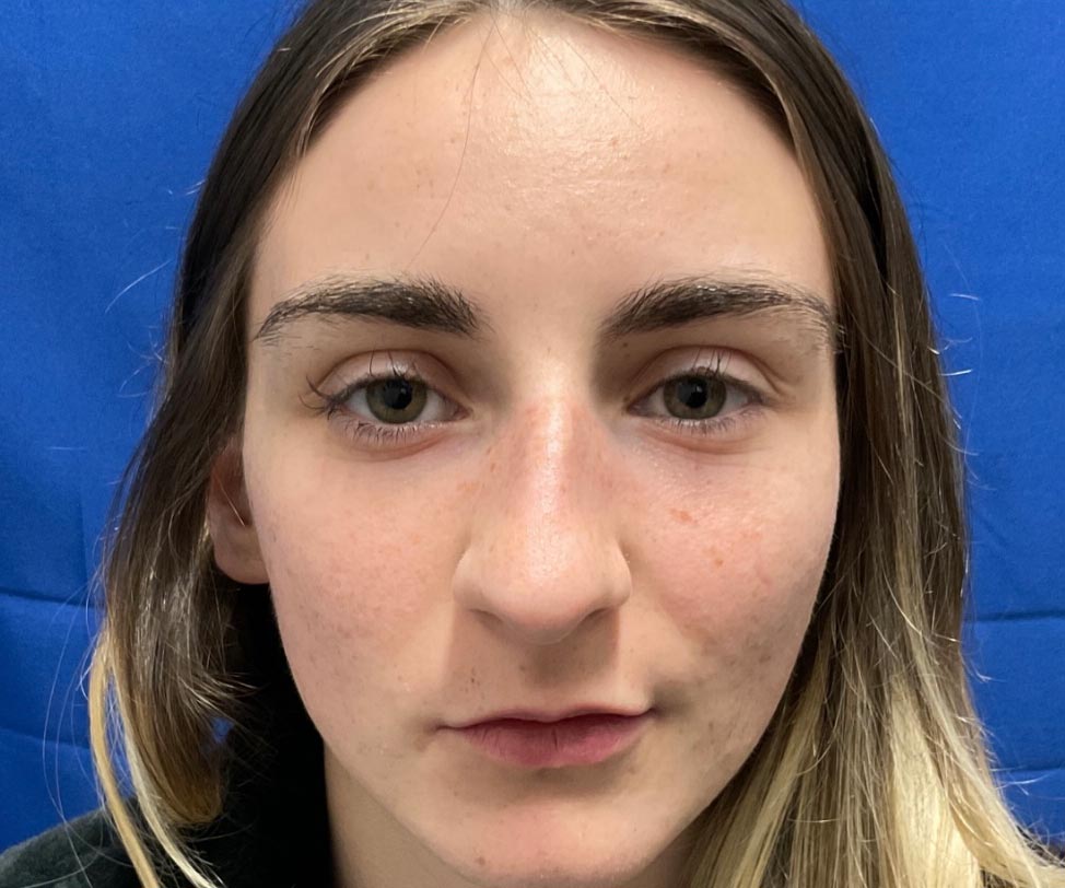 22 year old female shown 6 months after closed rhinoplasty. Her surgery involved dorsal hump reduction, tip elevation with cartilage grafting and nasal shortening.