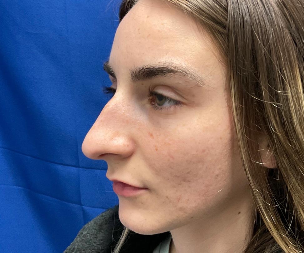 22 year old female shown 6 months after closed rhinoplasty. Her surgery involved dorsal hump reduction, tip elevation with cartilage grafting and nasal shortening.