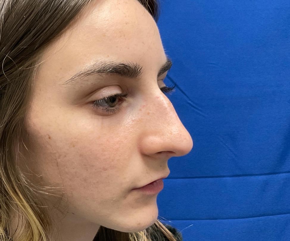 22 year old female shown 6 months after closed rhinoplasty. Her surgery involved dorsal hump reduction, tip elevation with cartilage grafting and nasal shortening.