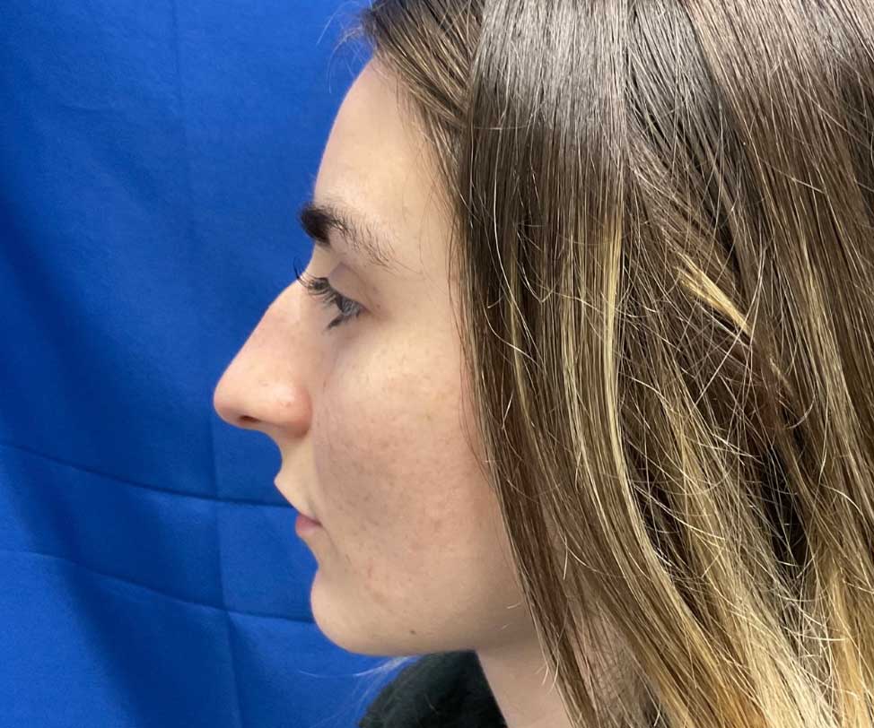 22 year old female shown 6 months after closed rhinoplasty. Her surgery involved dorsal hump reduction, tip elevation with cartilage grafting and nasal shortening.