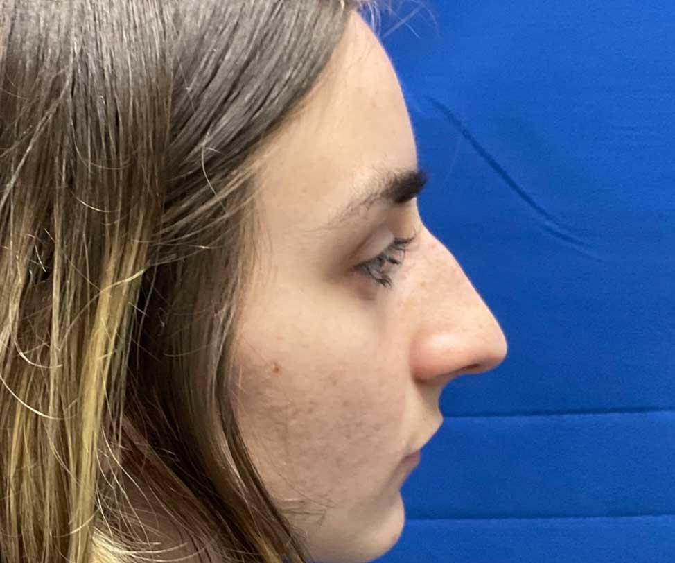 22 year old female shown 6 months after closed rhinoplasty. Her surgery involved dorsal hump reduction, tip elevation with cartilage grafting and nasal shortening.