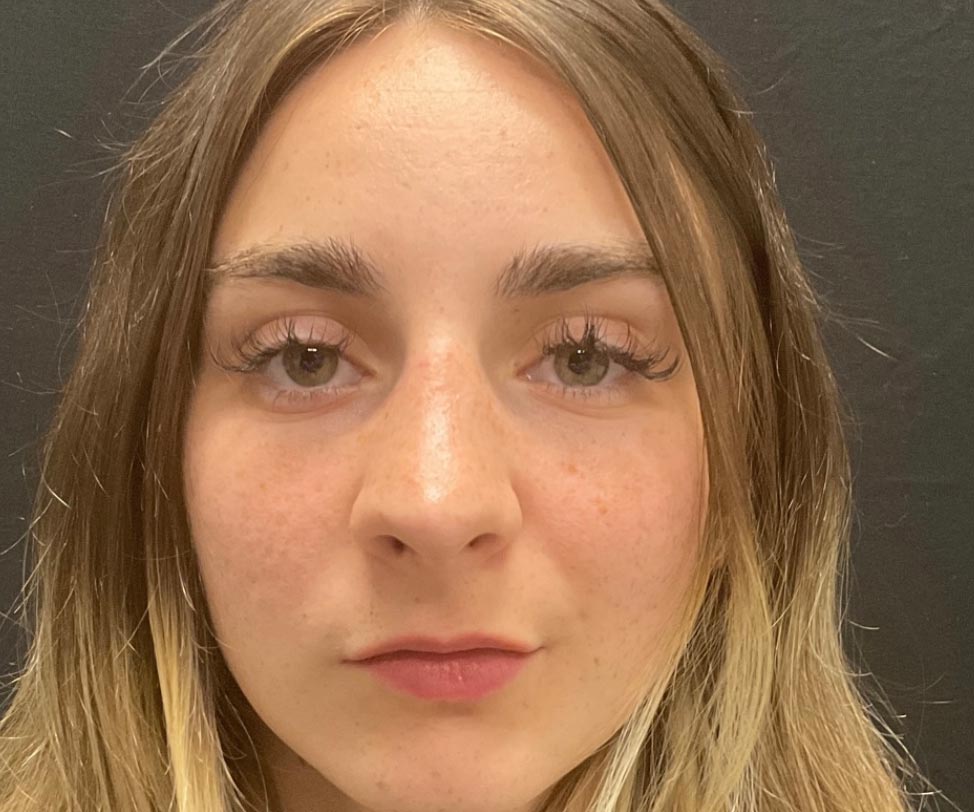 22 year old female shown 6 months after closed rhinoplasty. Her surgery involved dorsal hump reduction, tip elevation with cartilage grafting and nasal shortening.