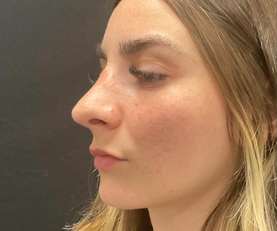 22 year old female shown 6 months after closed rhinoplasty. Her surgery involved dorsal hump reduction, tip elevation with cartilage grafting and nasal shortening.