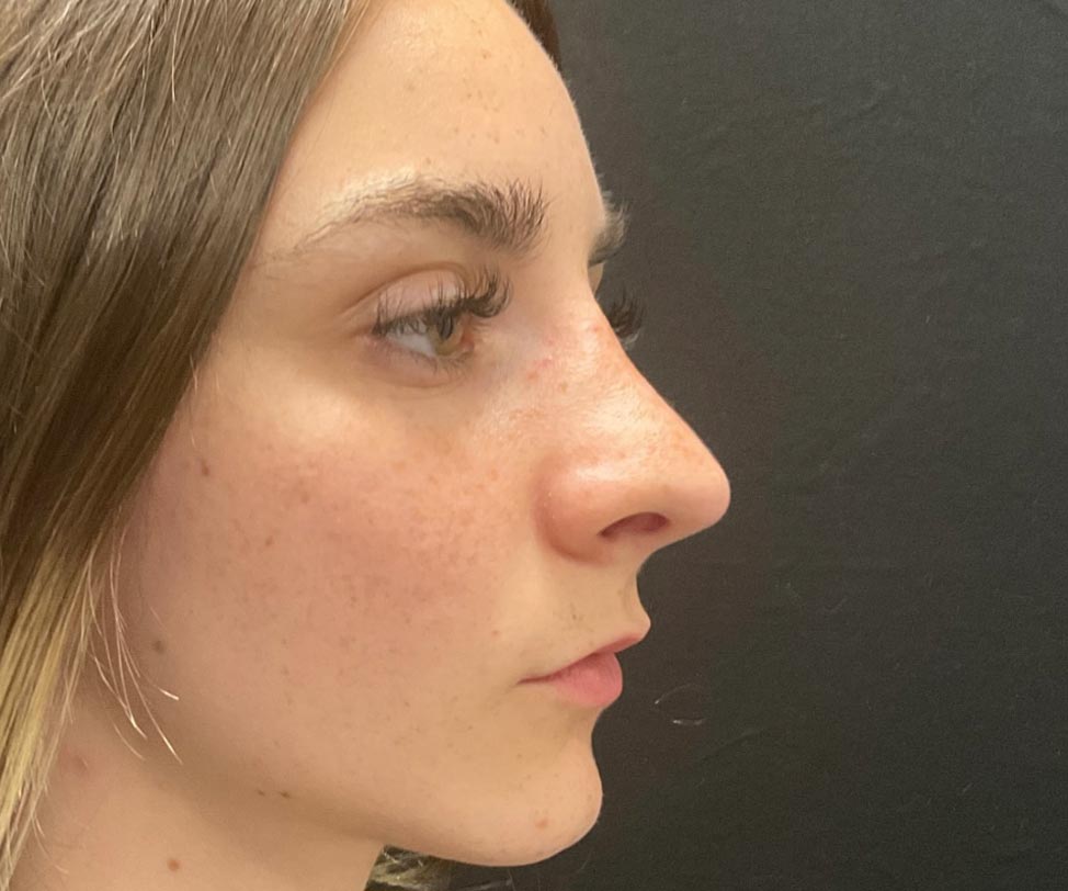 22 year old female shown 6 months after closed rhinoplasty. Her surgery involved dorsal hump reduction, tip elevation with cartilage grafting and nasal shortening.