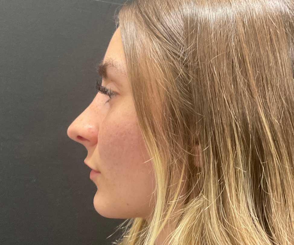 22 year old female shown 6 months after closed rhinoplasty. Her surgery involved dorsal hump reduction, tip elevation with cartilage grafting and nasal shortening.