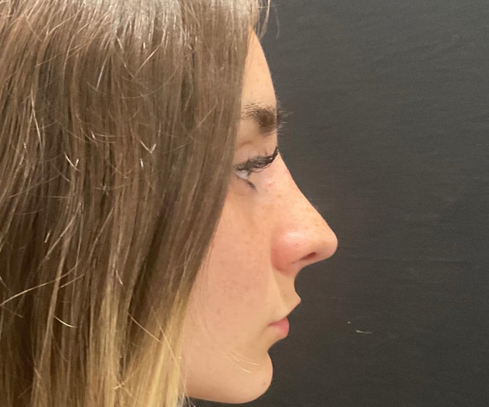 22 year old female shown 6 months after closed rhinoplasty. Her surgery involved dorsal hump reduction, tip elevation with cartilage grafting and nasal shortening.