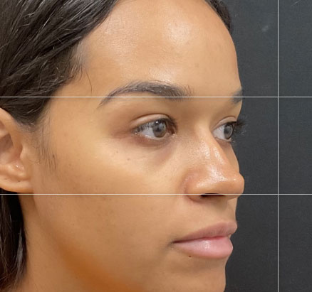 A mother in her 20s shown 2 months after functional closed rhinoplasty. Rib cartilage was used in her case to add definition and shape to her nose