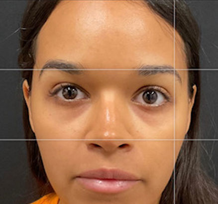 A mother in her 20s shown 2 months after functional closed rhinoplasty. Rib cartilage was used in her case to add definition and shape to her nose