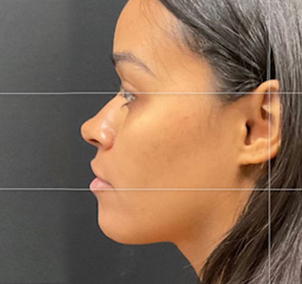 A mother in her 20s shown 2 months after functional closed rhinoplasty. Rib cartilage was used in her case to add definition and shape to her nose