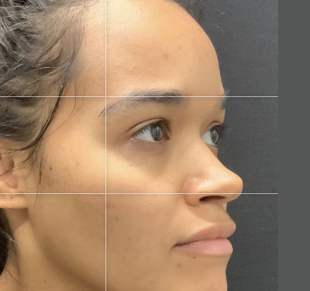 A mother in her 20s shown 2 months after functional closed rhinoplasty. Rib cartilage was used in her case to add definition and shape to her nose