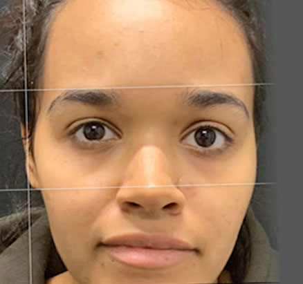 A mother in her 20s shown 2 months after functional closed rhinoplasty. Rib cartilage was used in her case to add definition and shape to her nose