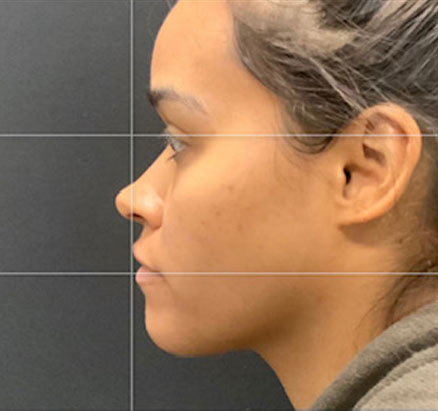 A mother in her 20s shown 2 months after functional closed rhinoplasty. Rib cartilage was used in her case to add definition and shape to her nose