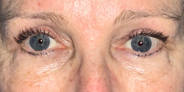 thyroid eye disease front after
