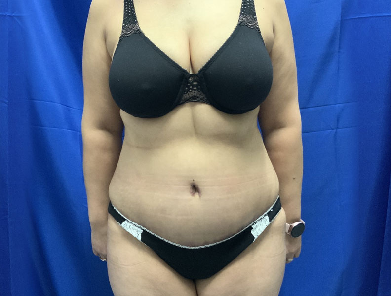 42 year old female 4 months after full abdominoplasty with liposuction of the upper abdomen and flanks