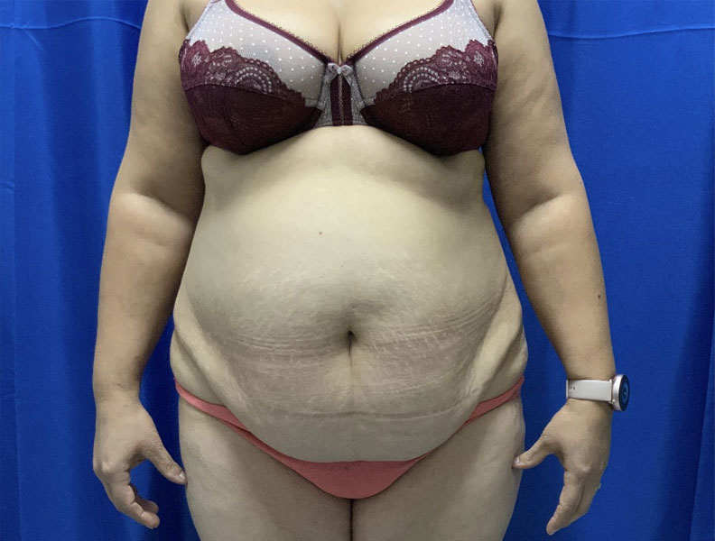 42 year old female 4 months after full abdominoplasty with liposuction of the upper abdomen and flanks