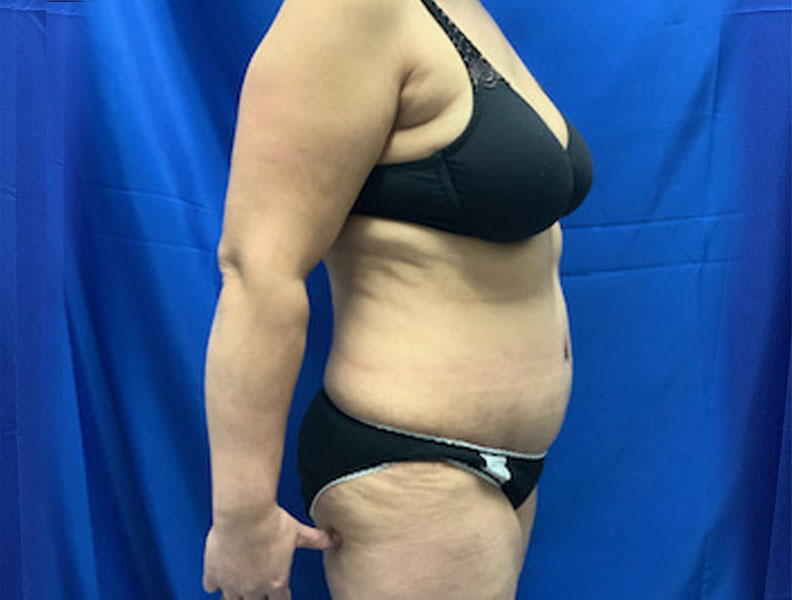 42 year old female 4 months after full abdominoplasty with liposuction of the upper abdomen and flanks