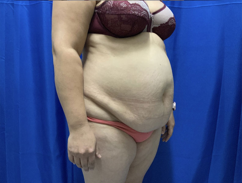 42 year old female 4 months after full abdominoplasty with liposuction of the upper abdomen and flanks