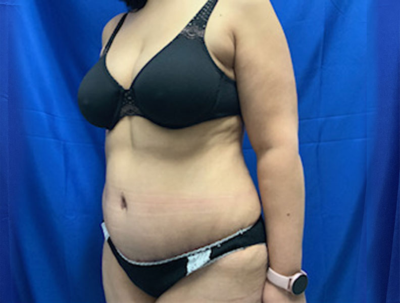 42 year old female 4 months after full abdominoplasty with liposuction of the upper abdomen and flanks